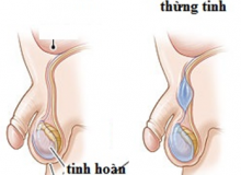 NANG NƯỚC THỪNG TINH Ở TRẺ NHỎ